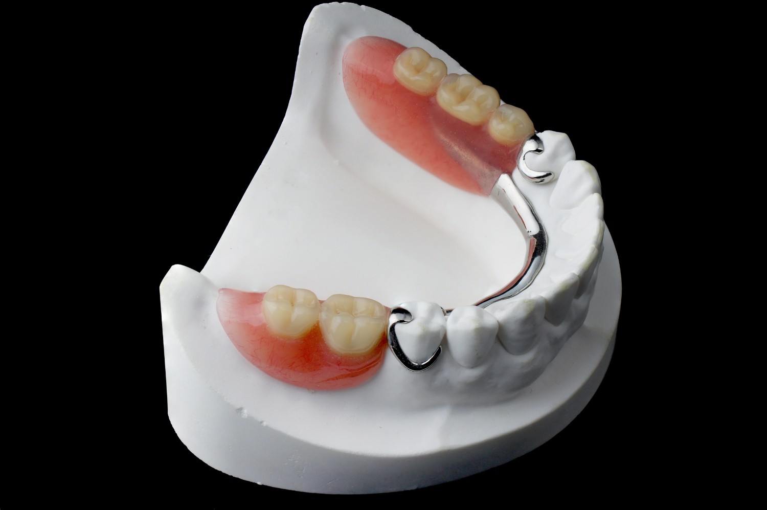 Removable Partial Denture RPD at Apex Dental Care Bhadrak